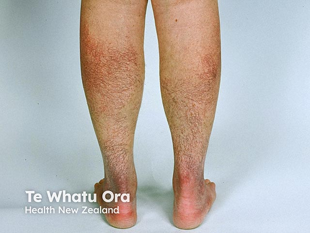 Cutaneous collagenous vasculopathy in skin of colour