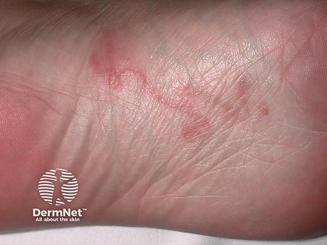 The track of larva migrans on the foot