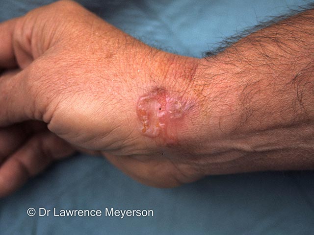 Larva mgrans on the wrist