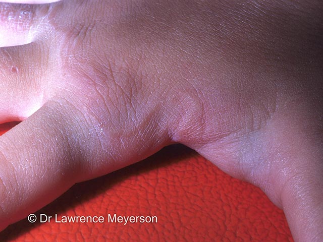 Larva migrans on the hand