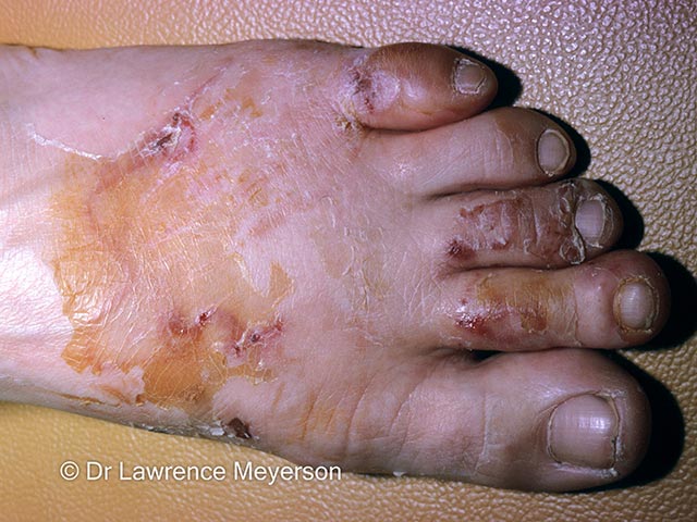 Multiple larva migrans tracks on the foot
