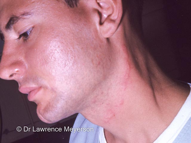 Larva migrans on the neck