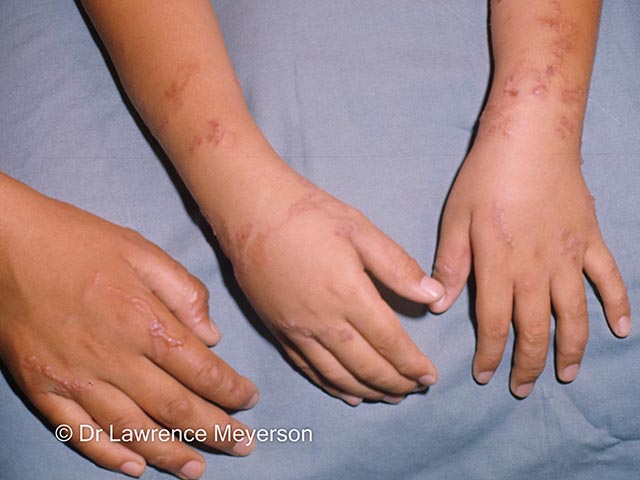 Larva migrans on the hands
