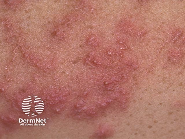 Vesicular reaction to larva migrans