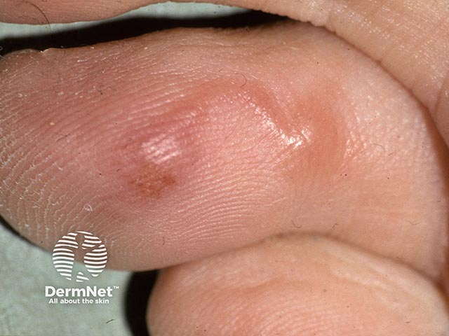 A larva migrans track on a toe