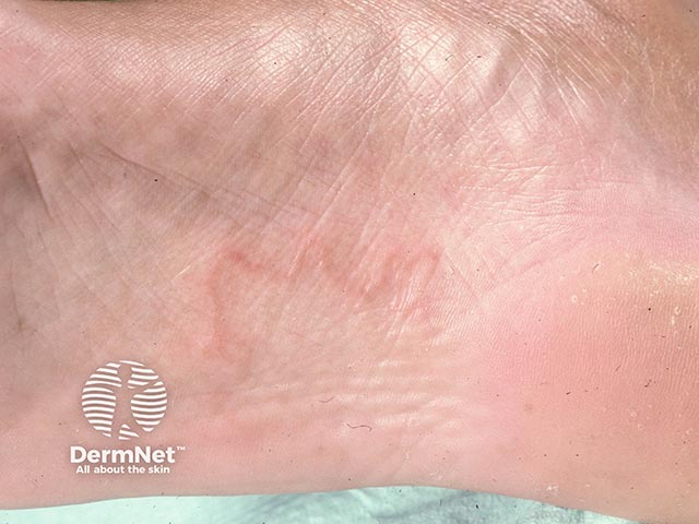 Larva migrans on the foot