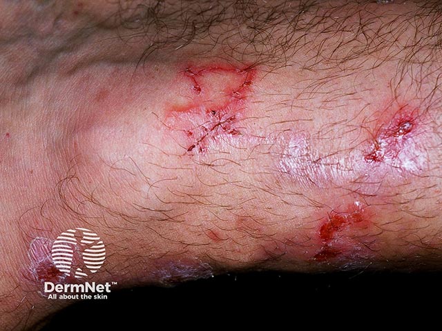 Larva migrans lesions on the lower leg