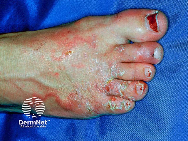 Larva migrans on the foot