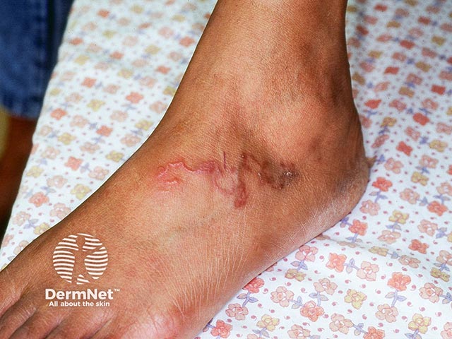 Larva migrans on the ankle