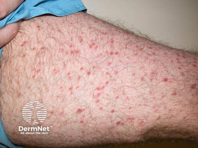 Red-brown maculopapules typical of adult-onset urticaria pigmentosa