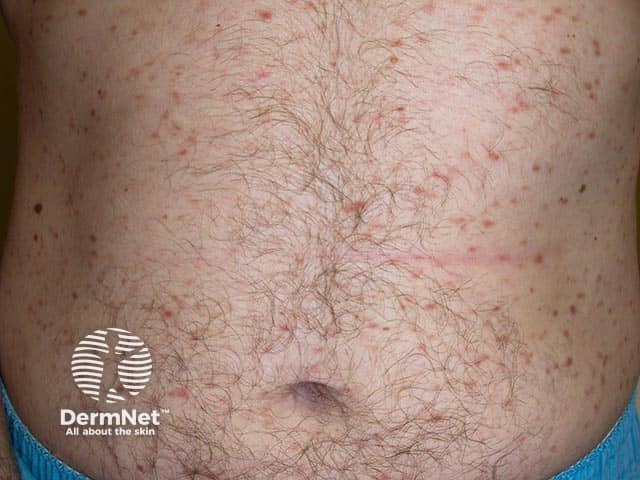 Red-brown papules of adult-onset urticaria pigmentosa on the abdomen