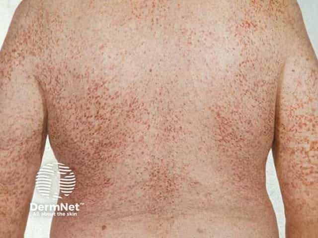 Red-brown monomorphic maculopapules in adult-onset urticaria pigmentosa