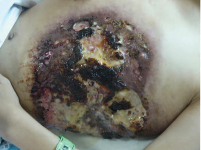 Cutaneous mucormycosis: chest wall in skin of colour.