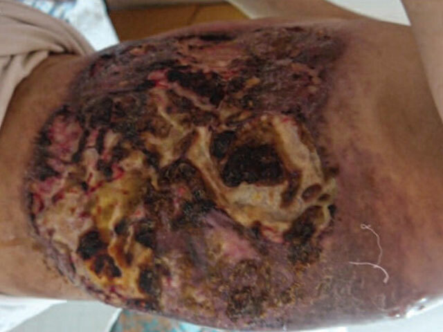 Cutaneous mucormycosis: chest wall in skin of colour.