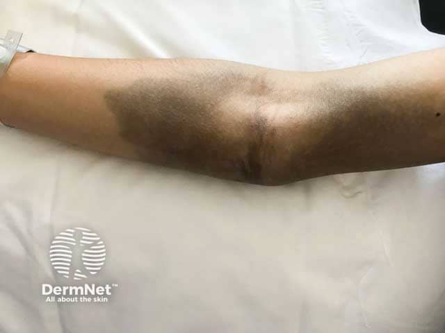 Skin staining due to extraversation of an iron infusion
