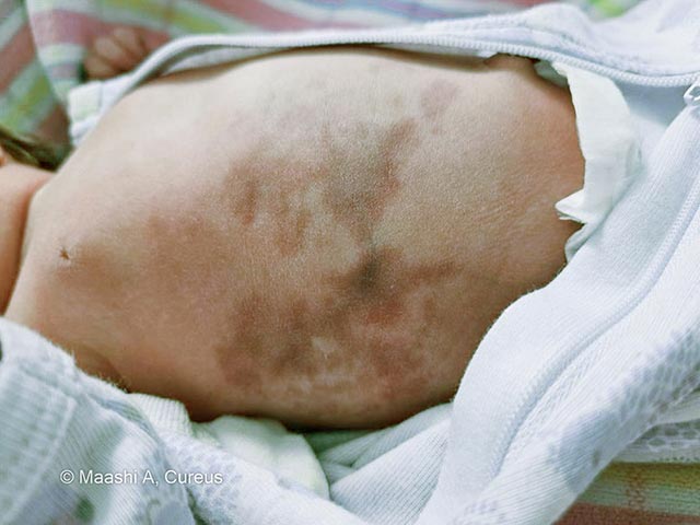 Neonate at birth showing widespread, reticulated, violaceous, and marble-like skin discoloration over the trunk, consistent with CMTC