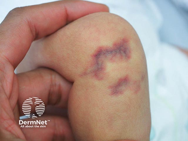 CMTC on the knee of a neonate