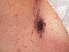 acute hiv rash chest