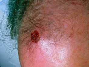 hiv lesions back