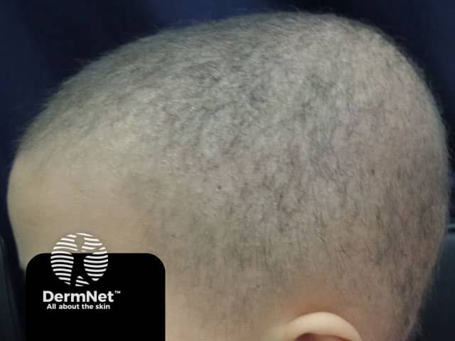 Short sparse hair in monilothrix