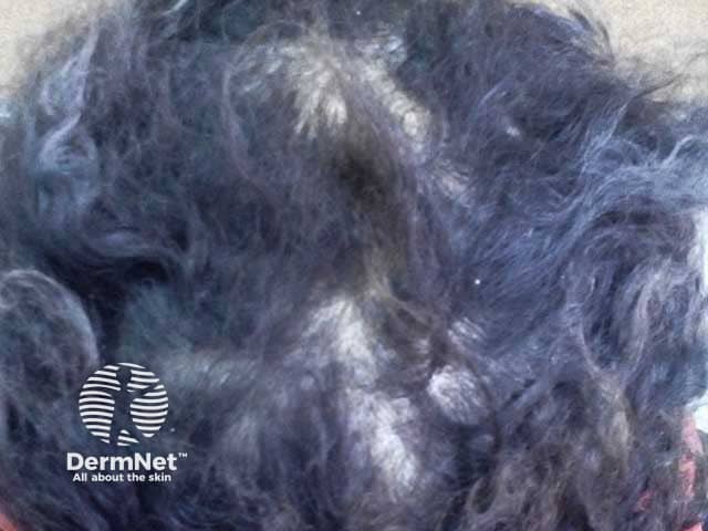 Clinical picture of a female patient with short brittle hair due to trichorrhexis nodosa