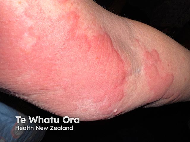 Large weals arising an hour after leaning on the elbow due to delayed pressure urticaria