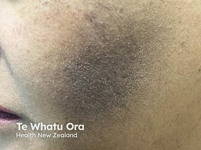 Spinulate demodecosis - tiny spicules of hyperkeratosis emanate from facial hair follicles giving a sandpaper-like texture