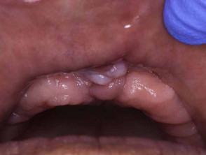 fibroma tongue