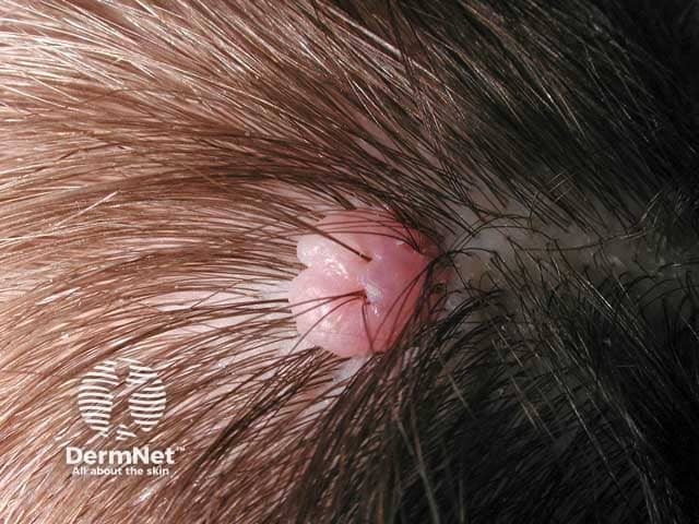 Benign cellular naevus on the parietal scalp