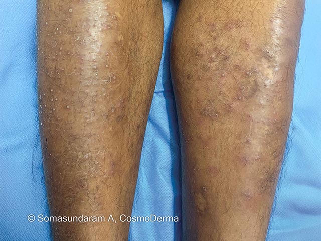 Multiple papules pustules and some atrophic scars due to dermatitiscruris pustulosa et atrophicans