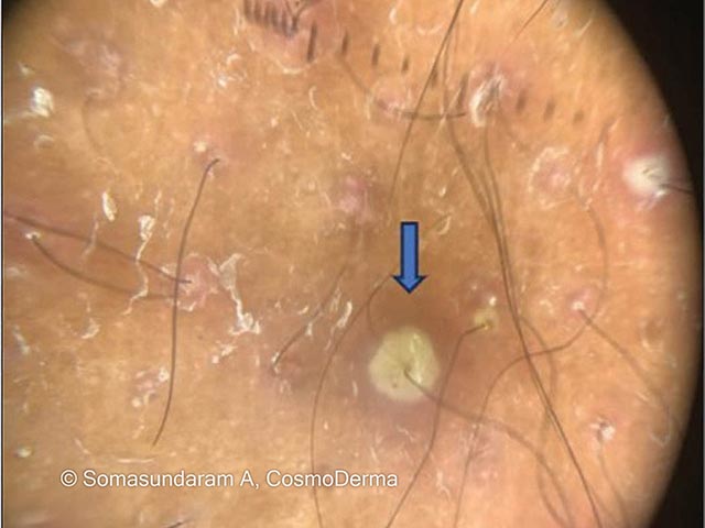 A follicular pustule on dermoscopy in dermatitis crurus pustulosa et atrophicans