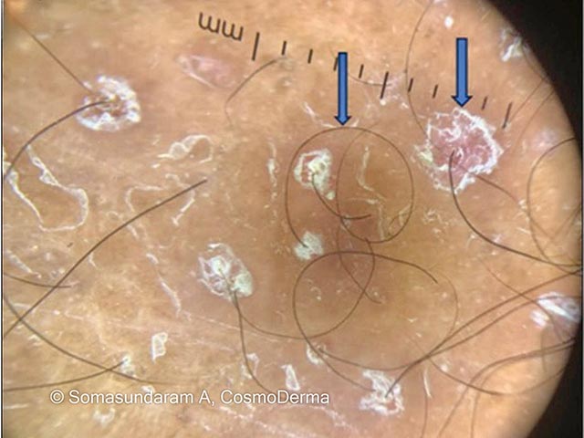 Scaly lesions at sites of previous pustules in dermatitis cruris pustulosa et atrophicans