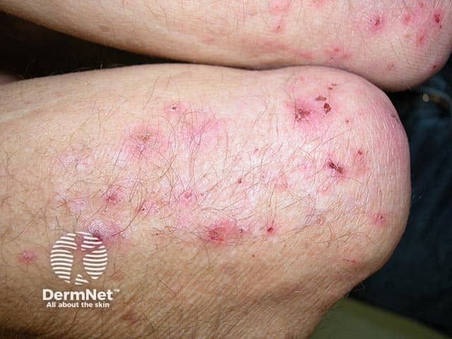 Excoriated vesicles on the elbows in dermatitis herpetiformis