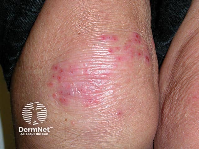 Clustered excoriated vesicles on the knee in dermatitis herpetiformis
