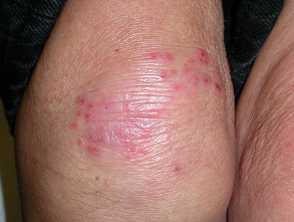 Dermatitis herpetiformis