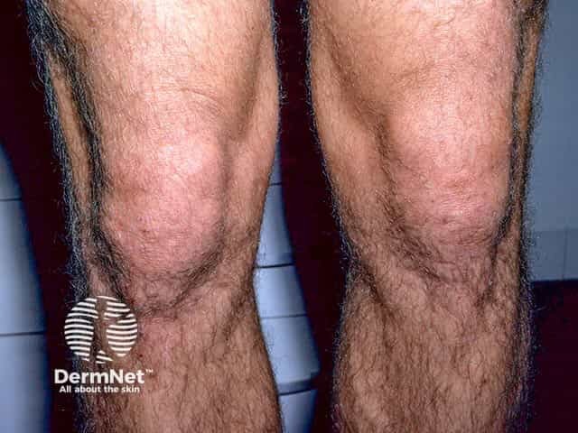 Knee lesions due to dermatitis herpetiformis