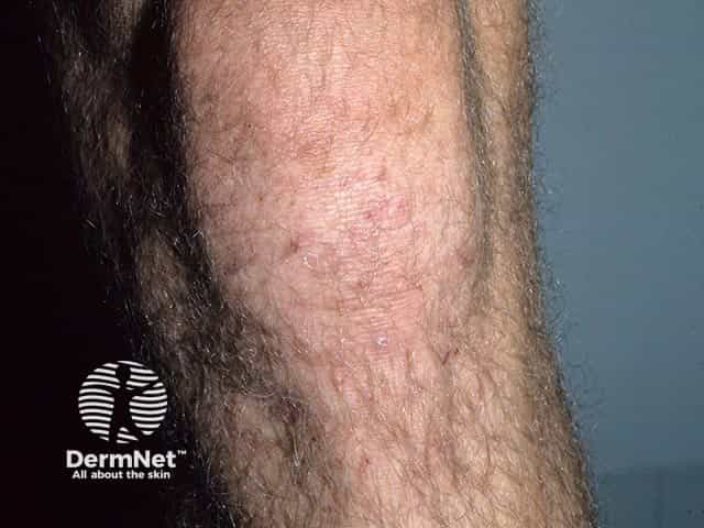 Excoriated vesicles on the knee in dermatitis herpetiformis.  A single intact vesicle is visible over the tibial tubercle