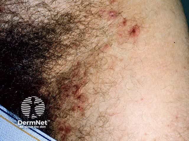 Abdominal and groin dermatitis herpetiformis