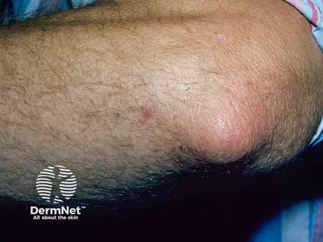 Mild elbow disease in dermatitis herpetiformis