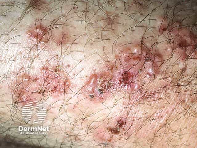 Clustered vesicles on the elbow in dermatitis herpetiformis