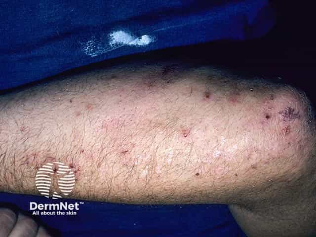 Excoriated vesicles on the arm in dermatitis herpetiformis.  A few intact vesicles are evident