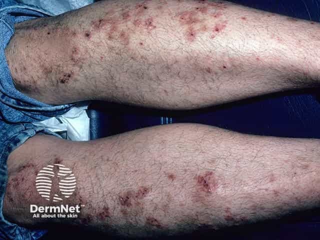 Annular lesions with peripheral vesicles in dermatitis herpetiformis