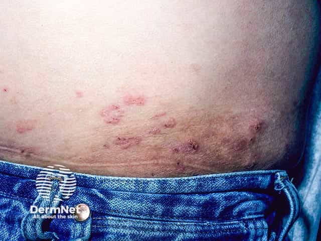 Annular lesions with peripheral vesicles on the abdomen in dermatitis herpetiformis