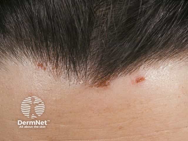 Hairline lesions in dermatitis herpetiformis