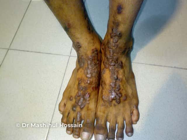 Prurigo-like lesions in dermatitis herpetiformis