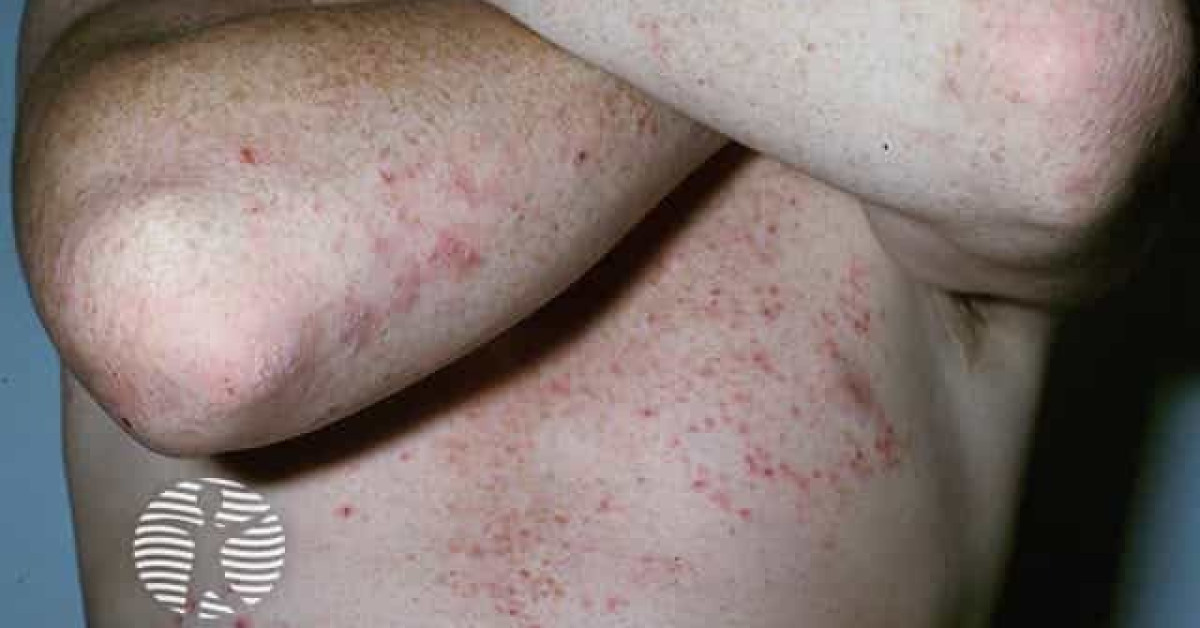 Dermatitis Herpetiformis Image Dermatitis Herpetiformis Image