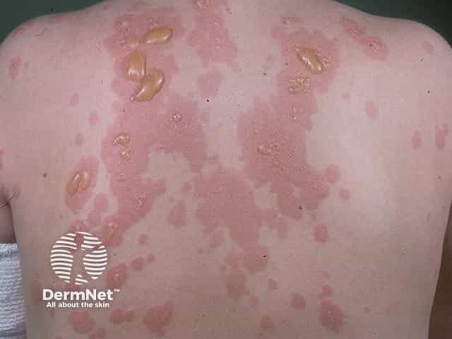 Urticated erythema surmounted by blisters in dermatitis herpetiformis