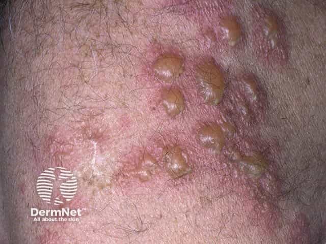 Herpetiform vesicles and blisters in dermatitis herpetiformis