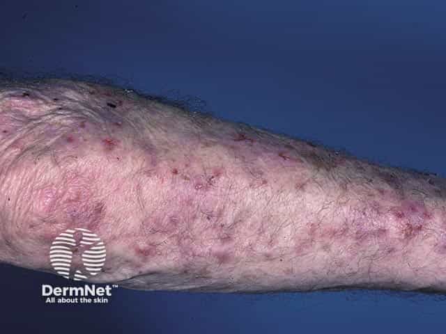 Excoriated plaques in dermatitis herpetiformis