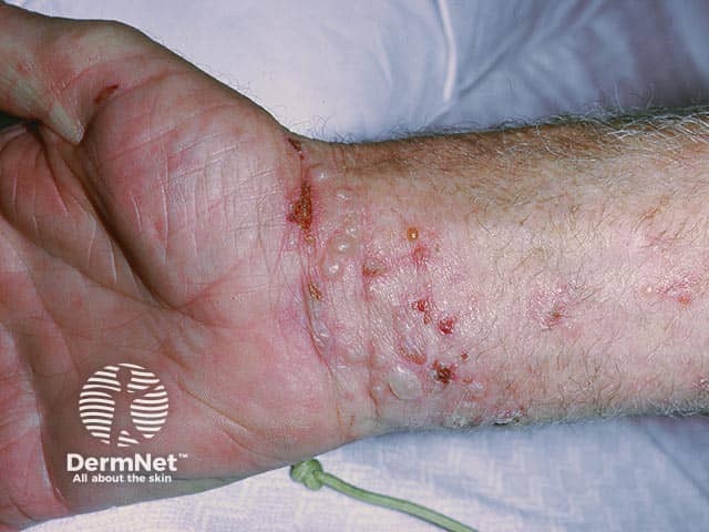 Vesicles and blisters on the wrists in dermatitis herpetiformis